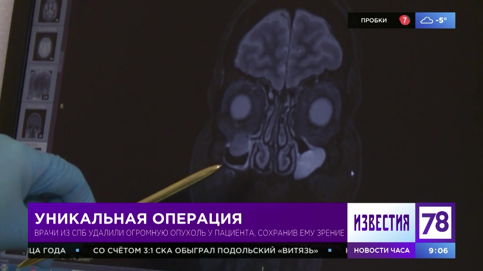 Врачи из Петербурга удалили у пациента огромную опухоль, сохранив ему зрение